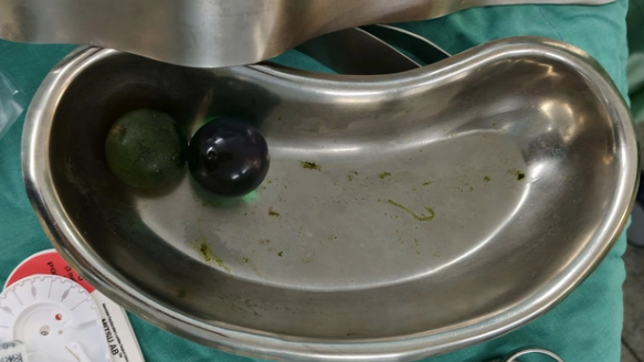 Nhiều trẻ nhỏ bị tắc ruột do nuốt hạt nở đồ chơi